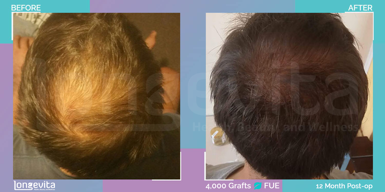 FUE hair transplant before and after, 4000 grafts, 4 zones covered