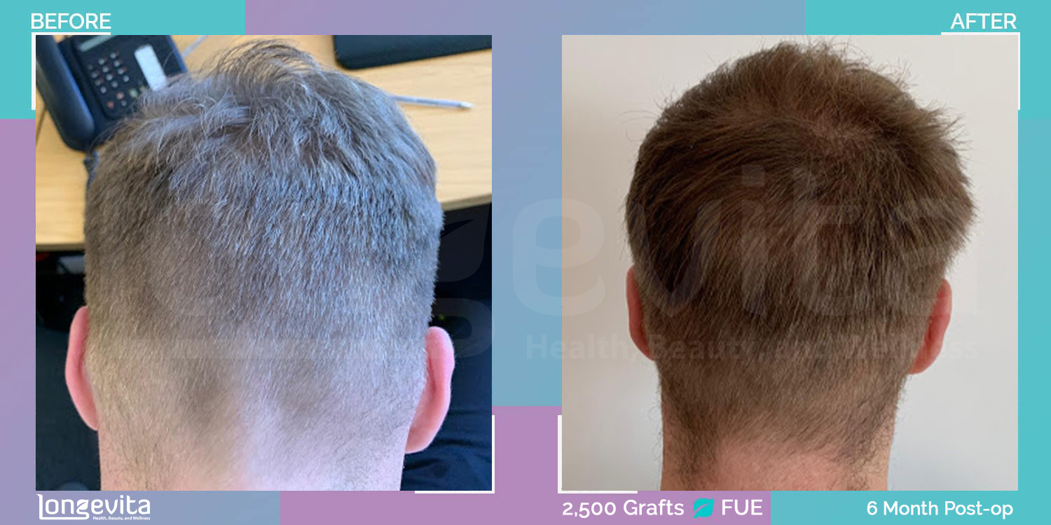 FUE hair transplant before and after, 2500 grafts, 4 zones covered, 30s male patient