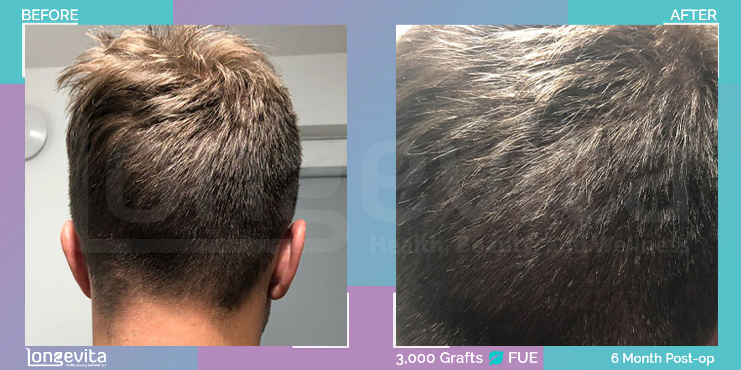 FUE hair transplant before and after, 3000 grafts, 3 zones covered