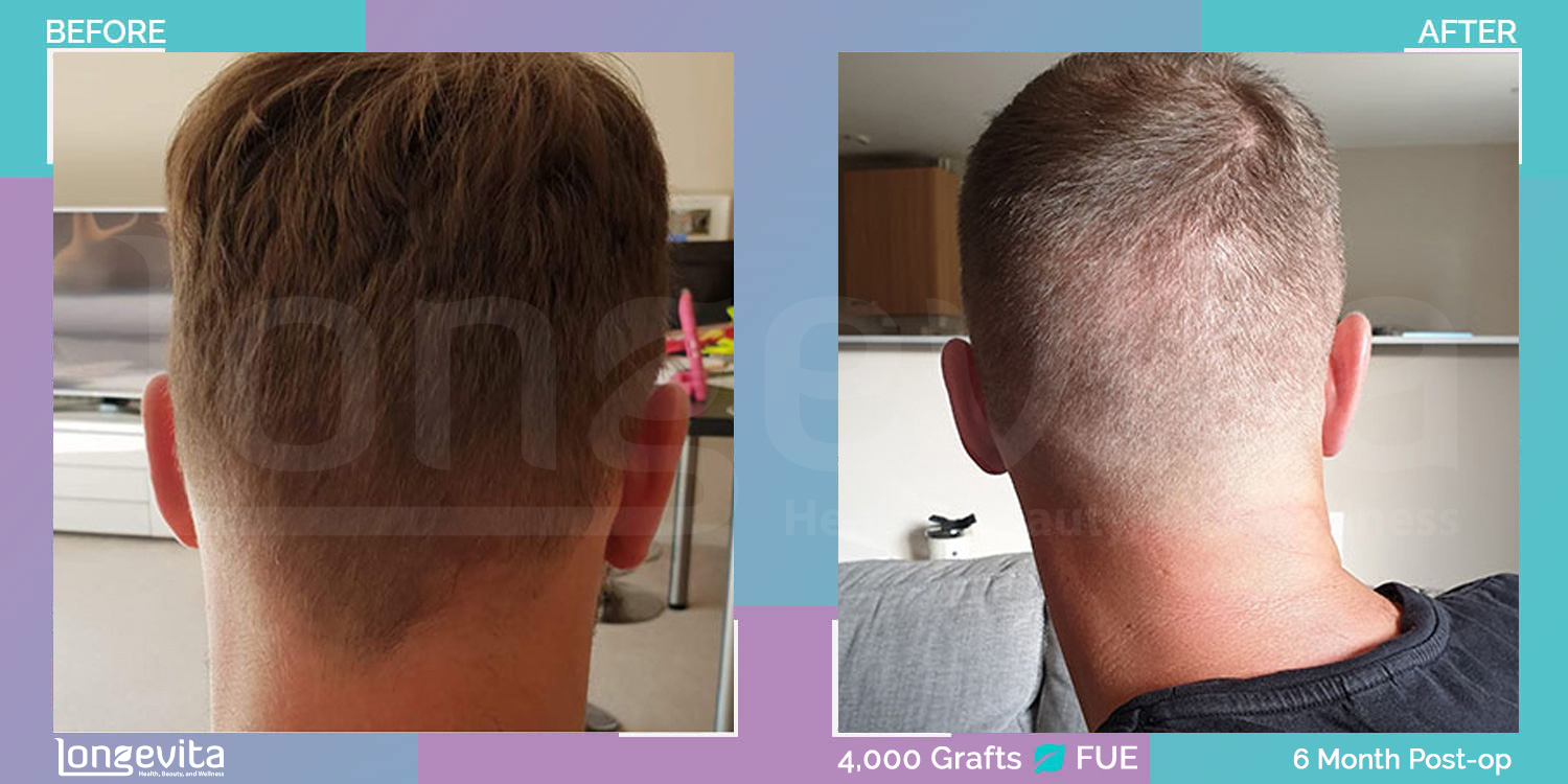 FUE hair transplant before and after, 4000 grafts, 5 zones covered