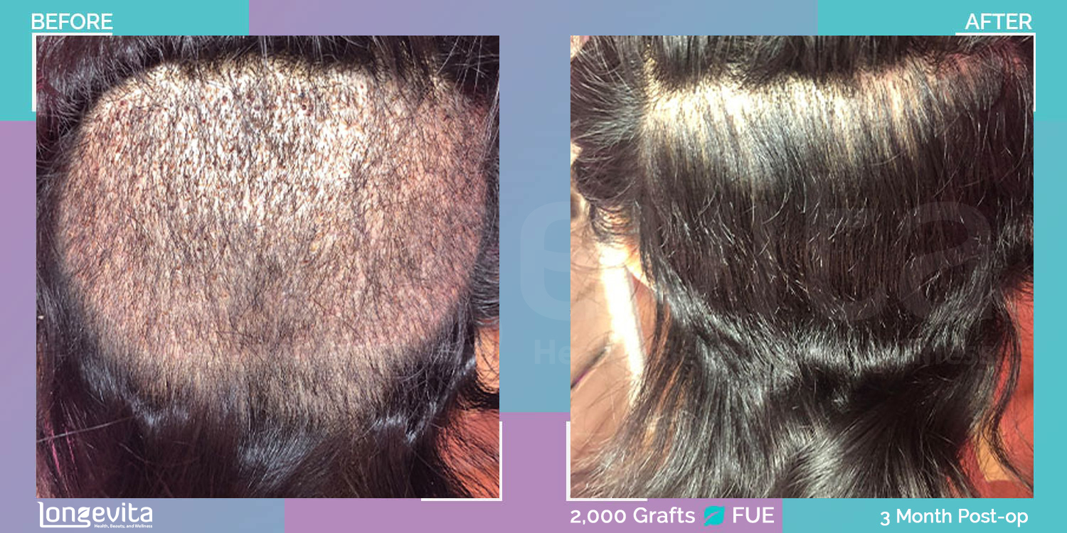 FUE hair transplant before and after, 2000 grafts, 2 zones covered, 20s female patient