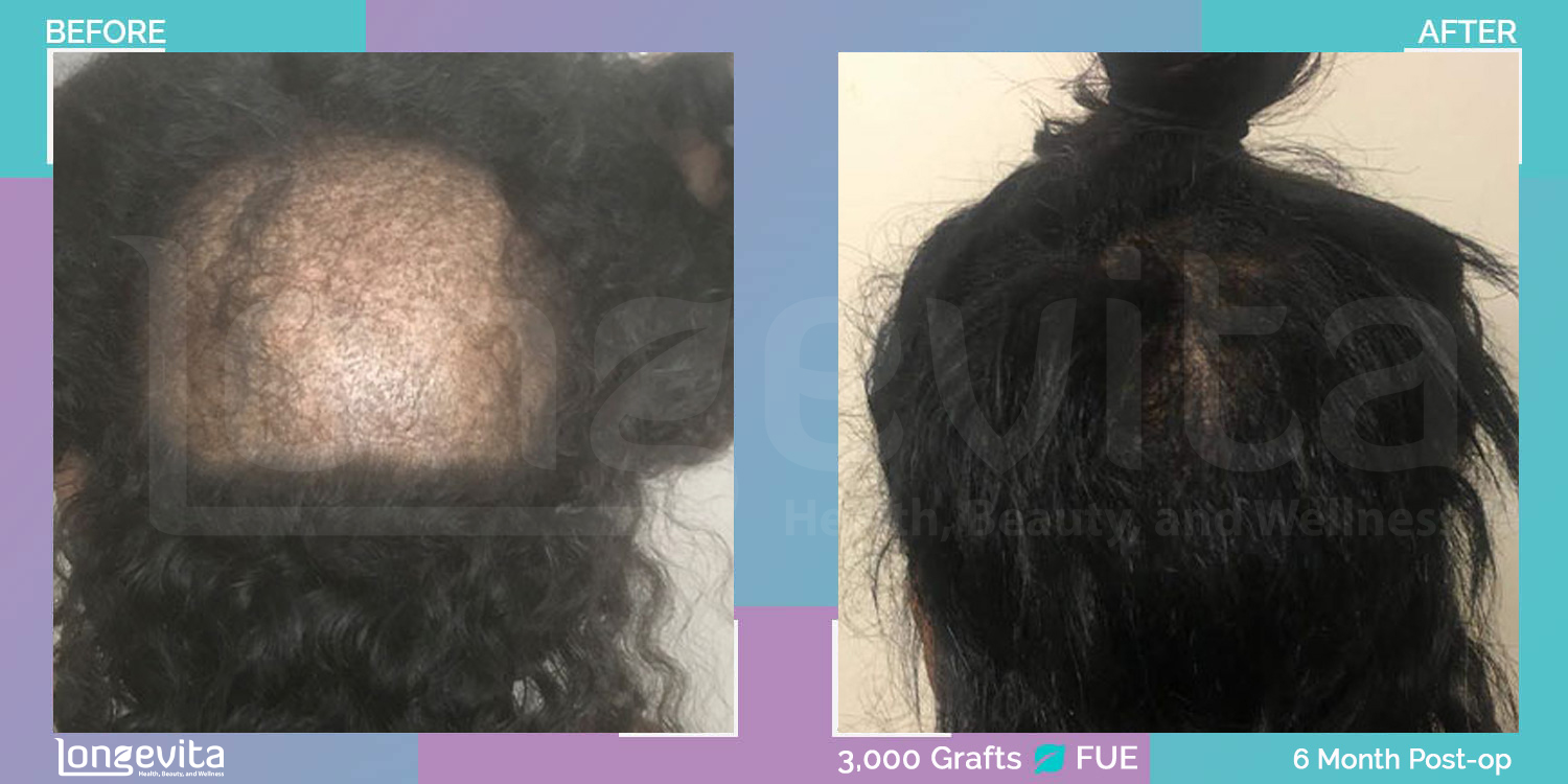 FUE hair transplant before and after, 3000 grafts, 2 zones covered, 20s female patient