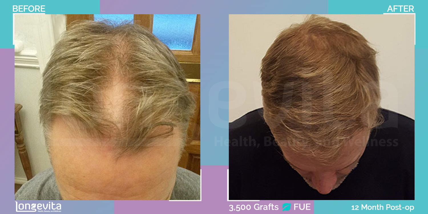 FUE hair transplant before and after, 3500 grafts, 6 zones covered, 40s male patient