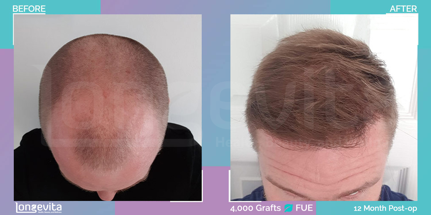 FUE hair transplant before and after, 4000 grafts, 6 zones covered