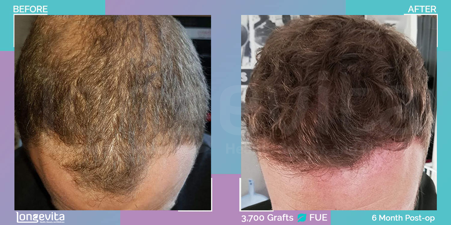 FUE hair transplant before and after, 3700 grafts, 3 zones covered, 30s male patient