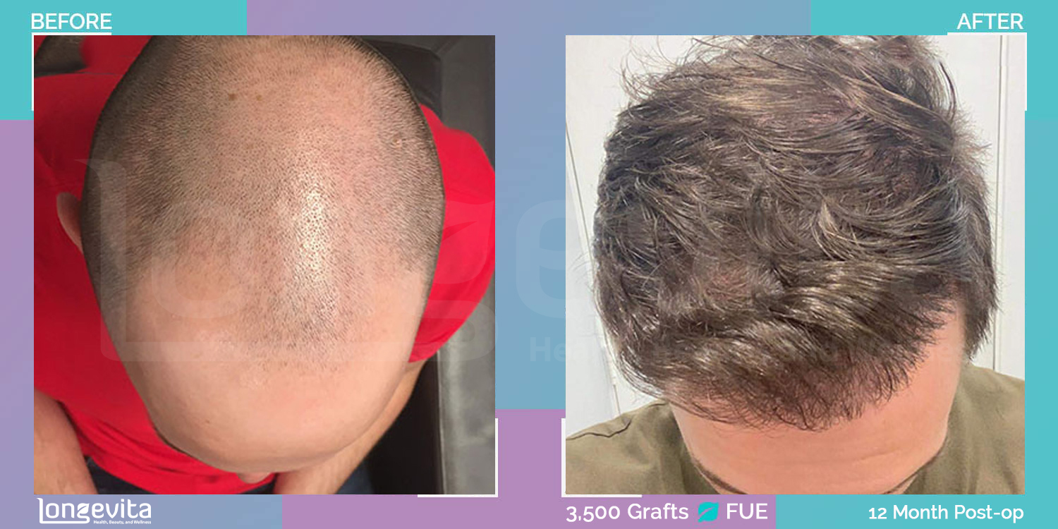 FUE hair transplant before and after, 3500 grafts, 6 zones covered