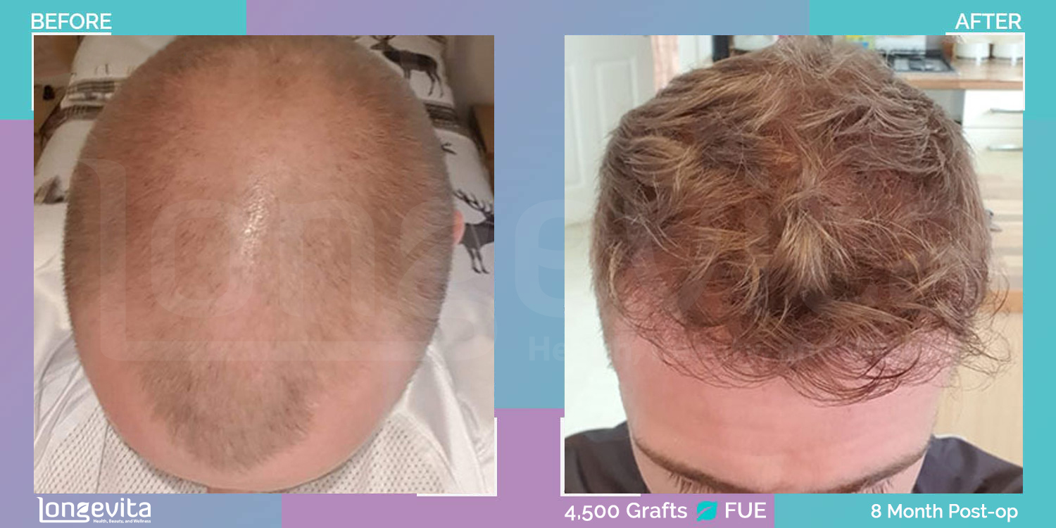 FUE hair transplant before and after, 4500 grafts, 6 zones covered, 30s male patient