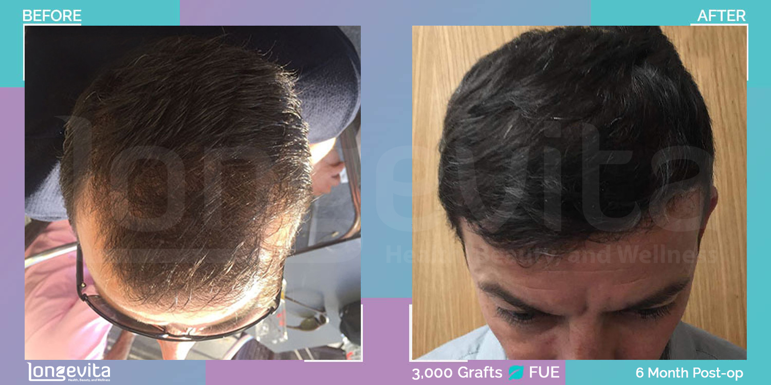 FUE hair transplant before and after, 3000 grafts, 6 zones covered, 40s male patient