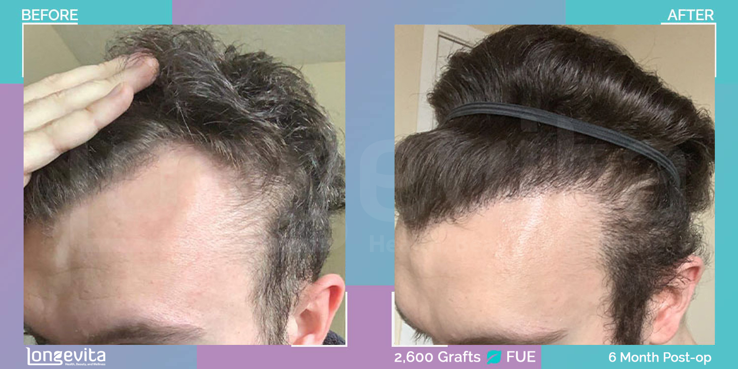 FUE hair transplant before and after, 2600 grafts, 2 zones covered