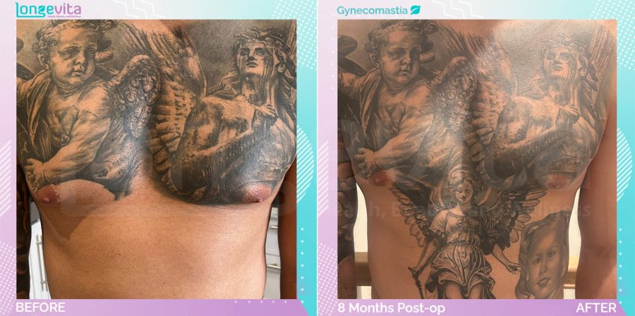 Gynecomastia before and after, Breast, 30s male patient