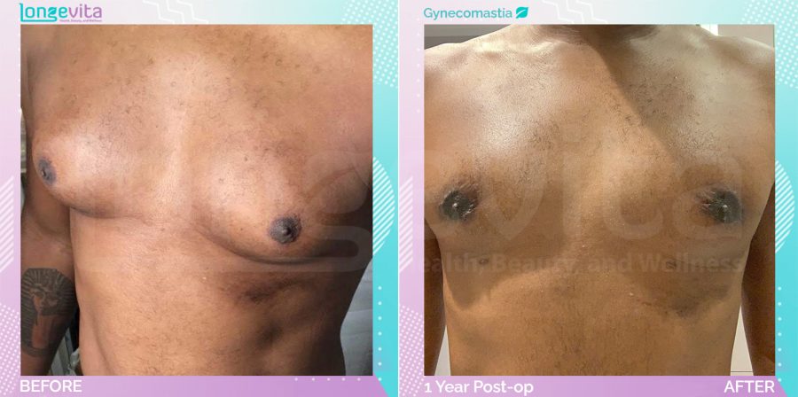 Gynecomastia before and after, Breast