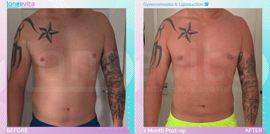 Gynecomastia and Liposuction before and after, Body, 30s male patient