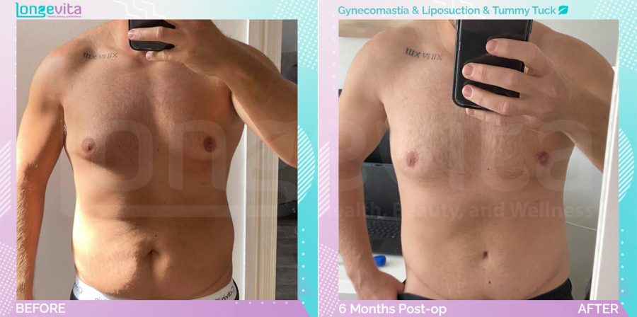 Gynecomastia and Liposuction and Tummy Tuck before and after, Body, 30s male patient