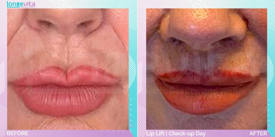 Lip Lift before and after, Face, 60s female patient