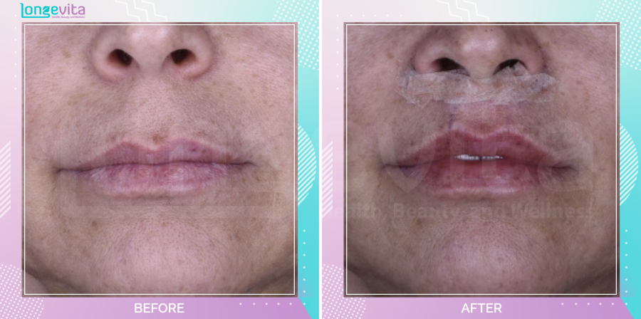 Lip Lift before and after, Face