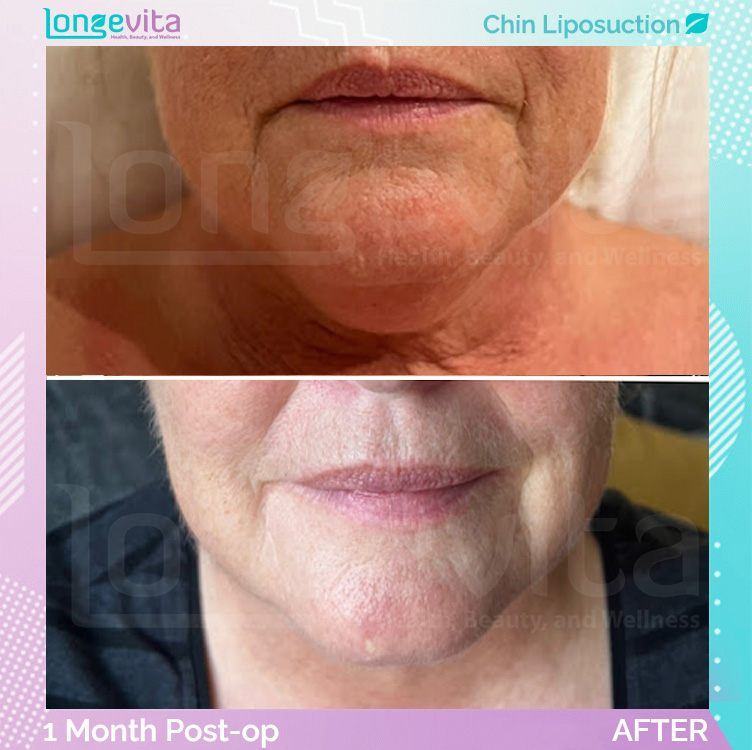 Liposuction before and after, Face, 50s female patient