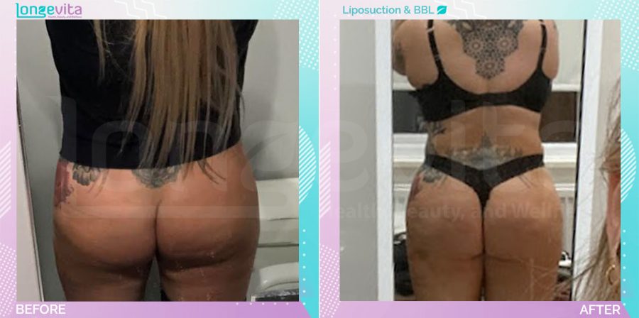 Bum Lift and Liposuction before and after, Body, 30s female patient