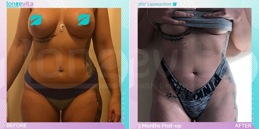 Liposuction before and after, Body, 30s female patient