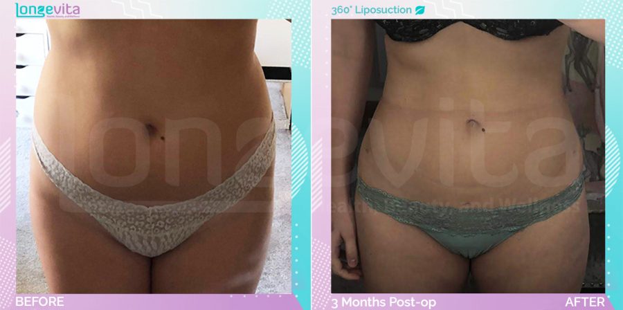 Liposuction before and after, Body