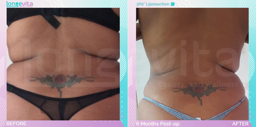 Liposuction before and after, Body, 40s female patient