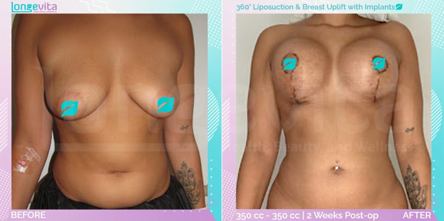 Breast Enlargement and Breast Lift and Liposuction before and after, Body, 20s female patient