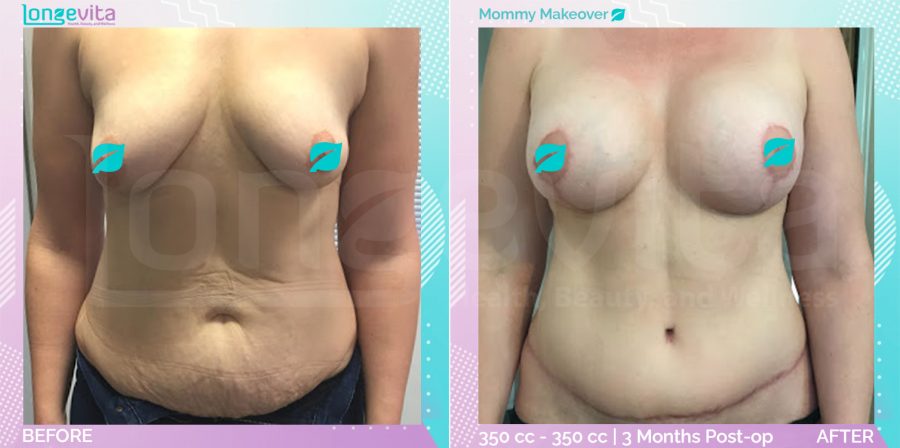 Breast Enlargement and Breast Lift and Liposuction and Tummy Tuck before and after, Body, 40s female patient