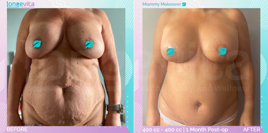 Breast Enlargement and Breast Lift and Tummy Tuck before and after, Body, 40s female patient