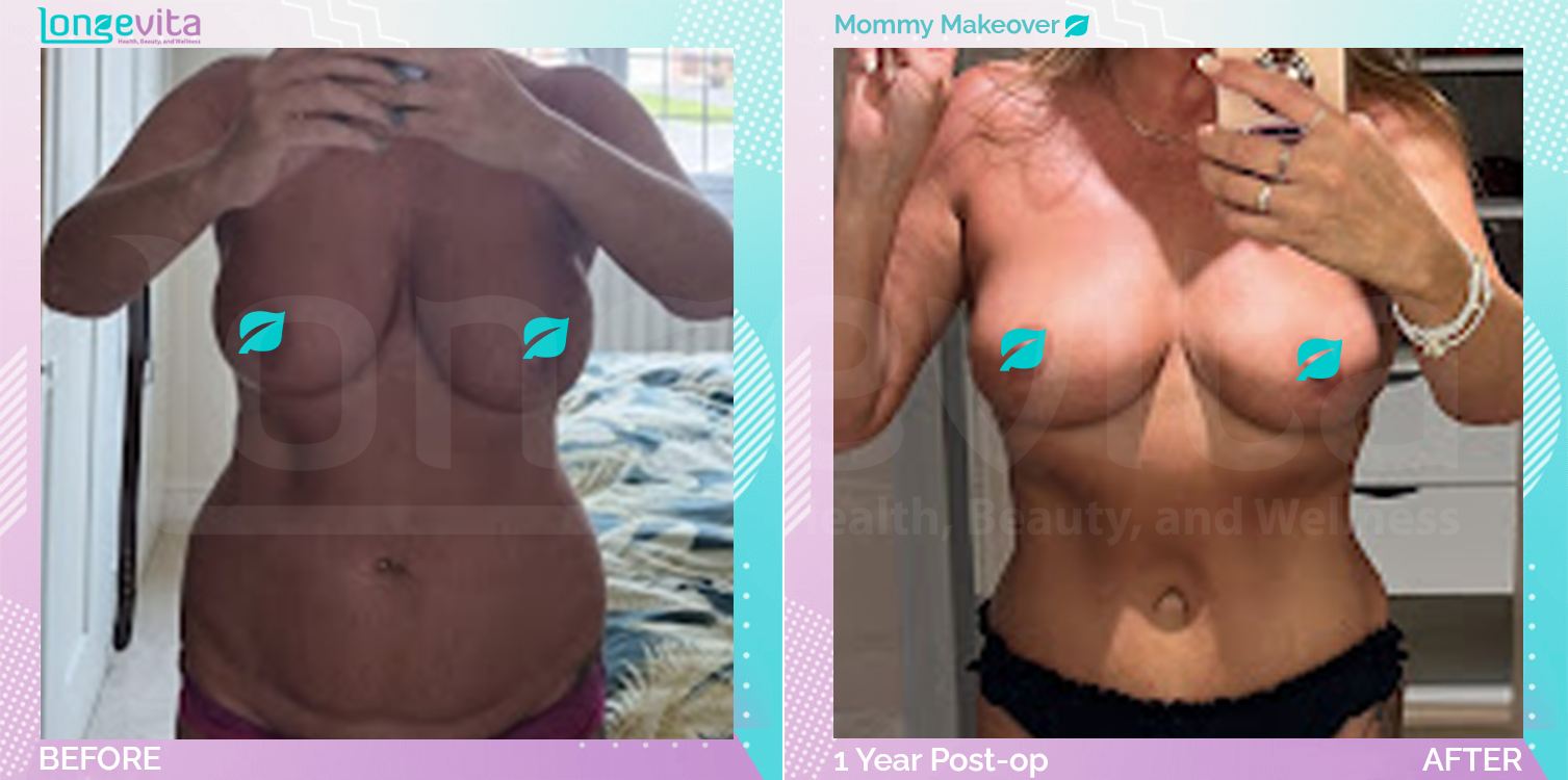 Breast Lift and Breast Reduction and Liposuction and Tummy Tuck before and after, Body, 40s female patient