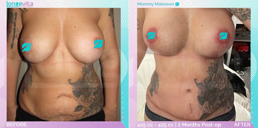 Breast Enlargement and Breast Lift and Liposuction and Tummy Tuck before and after, Body, 40s female patient