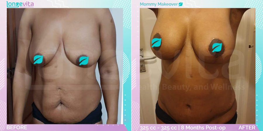 Breast Enlargement and Breast Lift and Liposuction and Tummy Tuck before and after, Body, 40s female patient