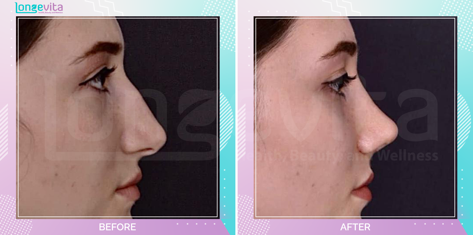 Rhinoplasty before and after, Face