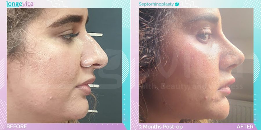 Septorhinoplasty before and after, Face, 30s female patient