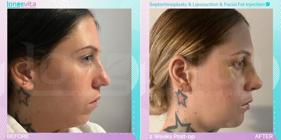Facial Fat Injection and Liposuction and Septorhinoplasty before and after, Face, 20s female patient