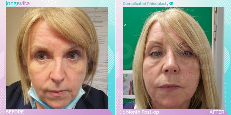 Complicated Rhinoplasty before and after, Face, female patient aged 50+