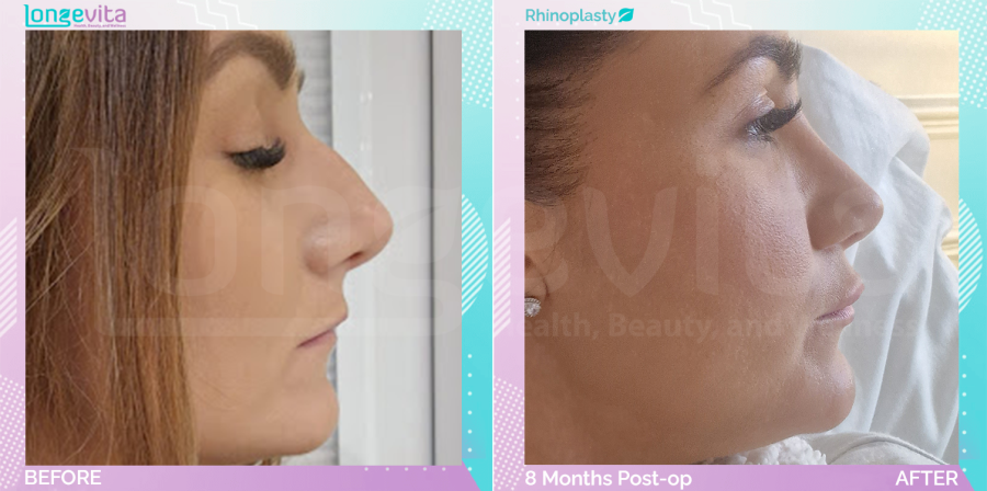 Rhinoplasty before and after, Face, 30s female patient