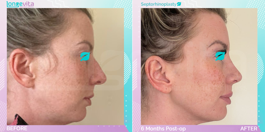 Septorhinoplasty before and after, Face, 30s female patient