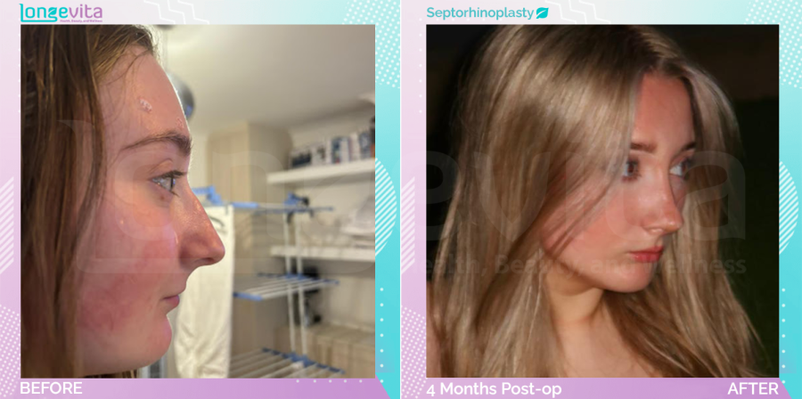 Septorhinoplasty before and after, Face
