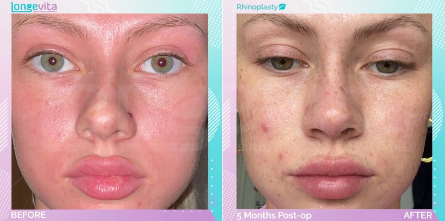 Rhinoplasty before and after, Face, 20s female patient