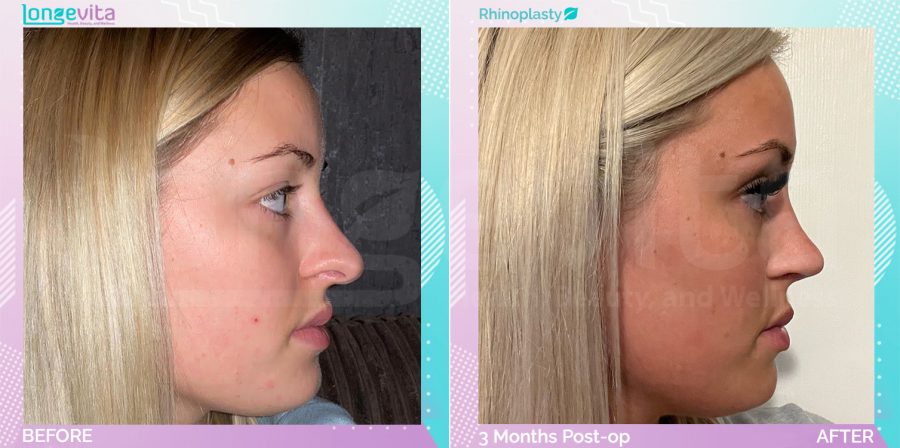 Rhinoplasty before and after, Face, 20s female patient
