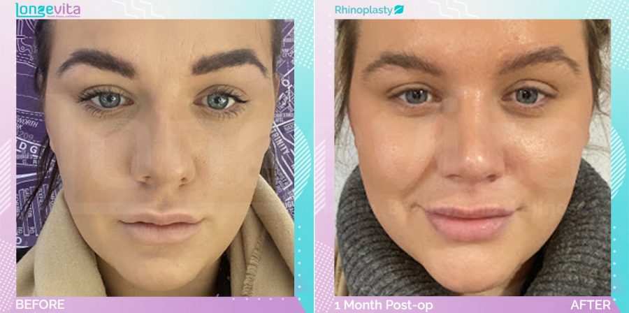 Rhinoplasty before and after, Face, 20s female patient