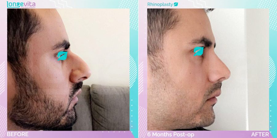 Rhinoplasty before and after, Face