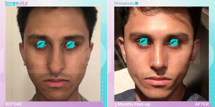 Rhinoplasty before and after, Face, 10s male patient