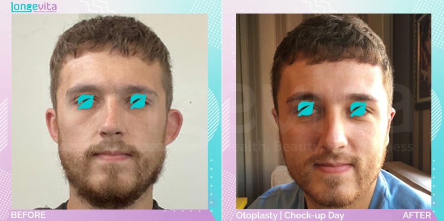 Otoplasty before and after, Face, 20s male patient