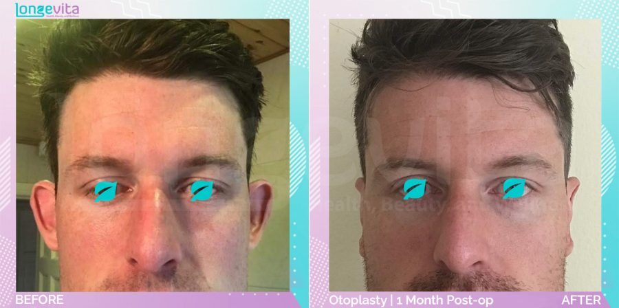 Otoplasty before and after, Face, 30s male patient