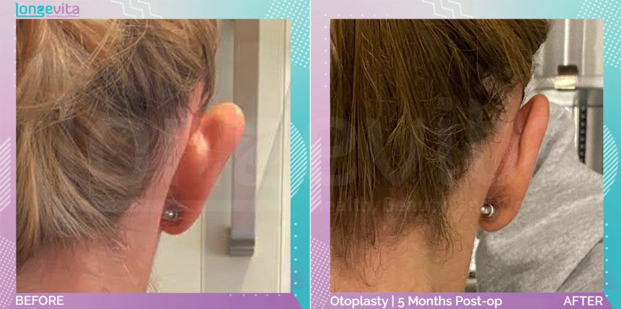 Otoplasty before and after, Face, 20s female patient