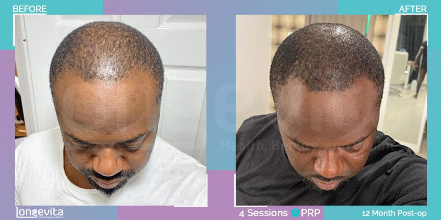 PRP hair transplant before and after, 20s male patient