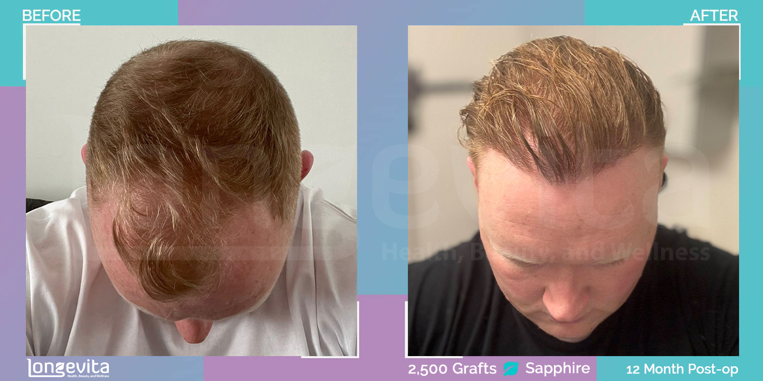 SAPPHIRE hair transplant before and after, 2500 grafts, 2 zones covered, 30s male patient