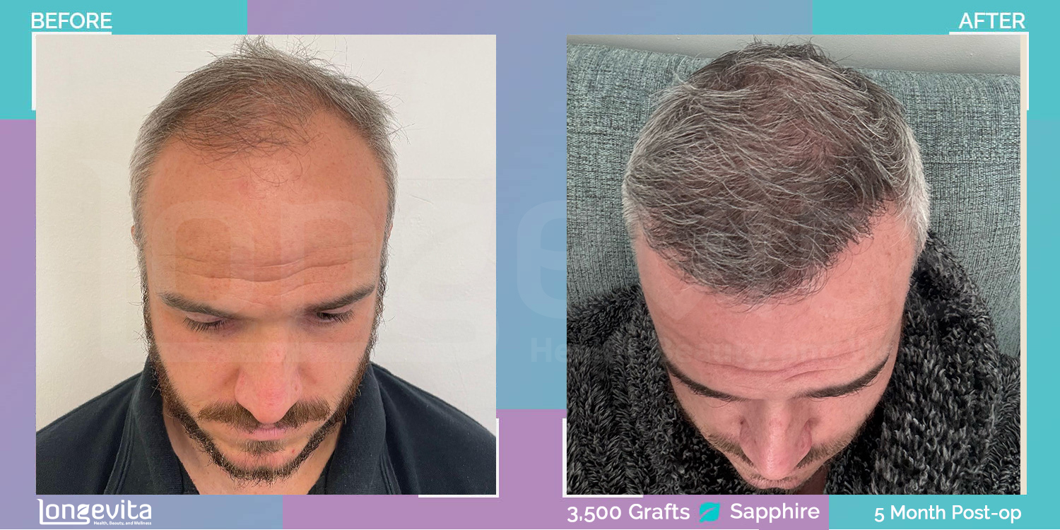 SAPPHIRE hair transplant before and after, 3500 grafts, 3 zones covered, 30s male patient