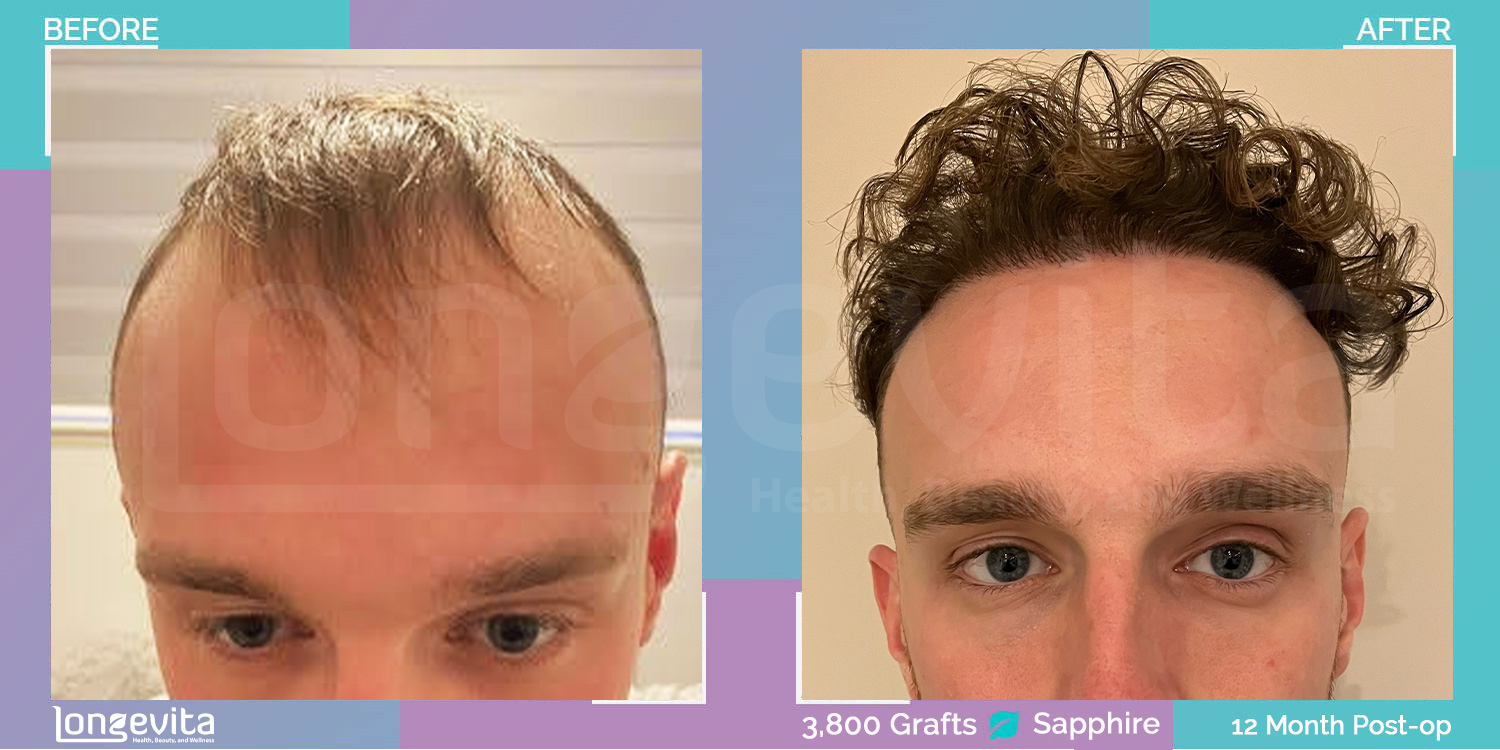 SAPPHIRE hair transplant before and after, 3800 grafts, 4 zones covered, 20s male patient