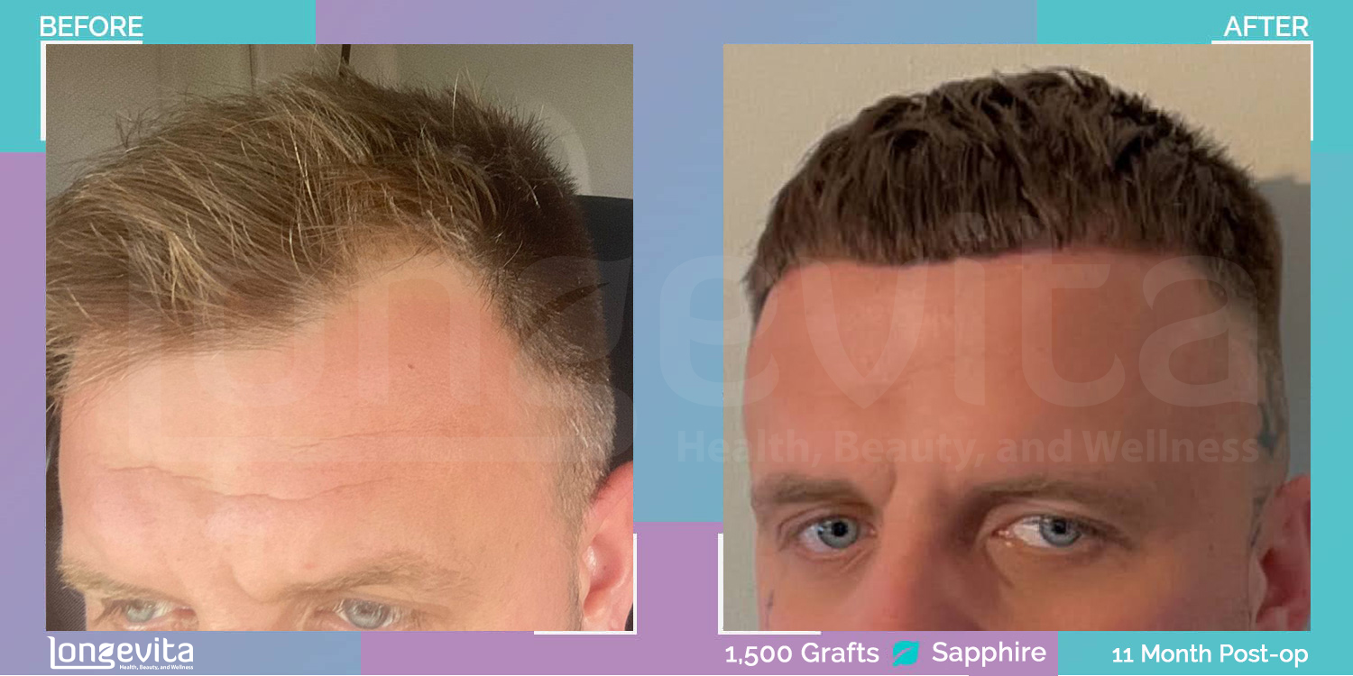 SAPPHIRE hair transplant before and after, 1500 grafts, 1 zone covered, 30s male patient